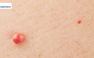 Waspada Kutil Kelamin!