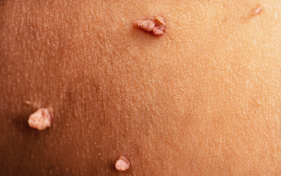 Mengenal Berbagai Jenis Kutil dan Cara Mengatasinya